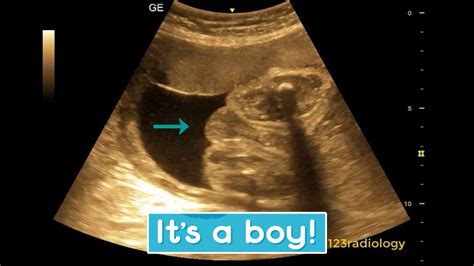 Ultrasound Showing Boy Baby Youtube