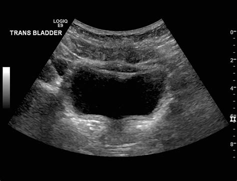 Bladder Debris On Ultrasound In The Emergency Department Correlation