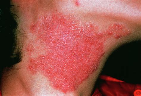 Fungal Skin Infection Photograph By Cnriscience Photo Library Fine