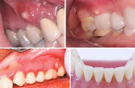 White Spots On Gums Baby Painful Pictures Above Below Teeth Hard