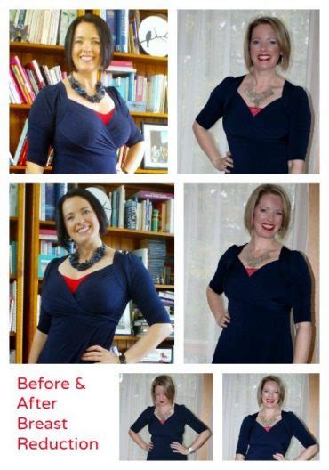 Breast Reduction Surgery Recovery Guide