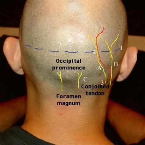 4 Surface Anatomy Of The Occipital Nerves A Greater Occipital Nerve B
