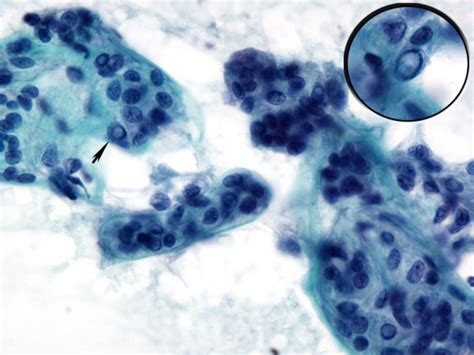 Cytology Of Htn Papanicolaou Stained Fine Needle Aspiration Of