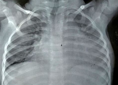 Chest X Ray Showing Apparent Cardiomegaly With Anterior Mediastinal