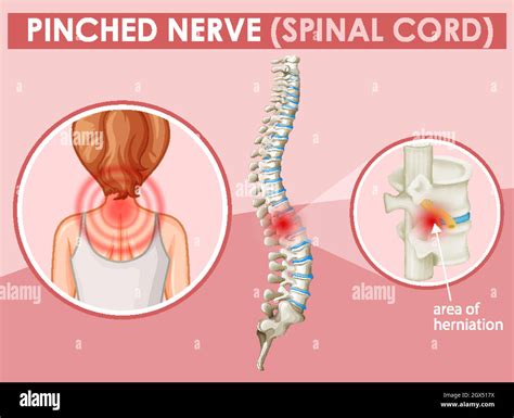 Diagram Showing Pinched Nerve In Human Stock Vector Image And Art Alamy