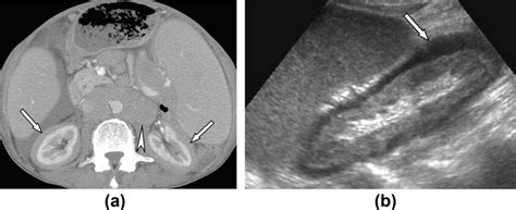 Perinephric Lymphoma In A 64 Year Old Man A Contrast Enhanced Ct