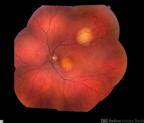 Choroidal Metastasis Retina Image Bank