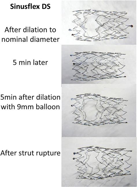 Behavior Of The Self Expanding Sinuspro Ds Stent See Text Download Scientific Diagram