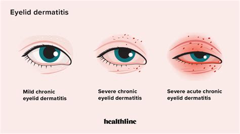 Eyelid Dermatitis Treatments Symptoms Causes And More
