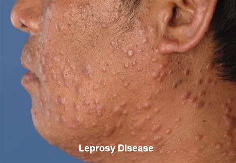 What Is Leprosy Disease And What Are The Symptoms Of Leprosy? | Health And Beauty