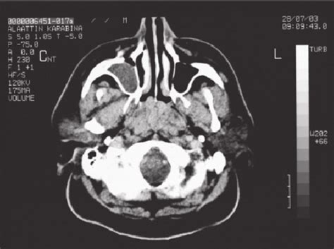 The Nasopharynx Ct Demonstrating The Mass Originating From The