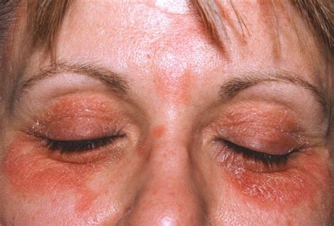 Eczema On Eyelids Causes Treatments And Cures Skincarederm