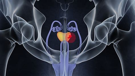 Radiation Extends Pfs In Recurrent Oligometastatic Prostate Cancer