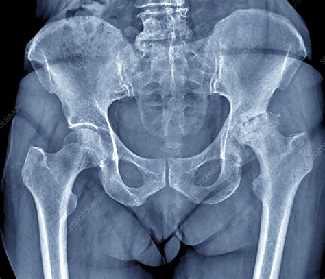 Osteoarthritis Of The Hip X Ray Stock Image C Science Photo Library