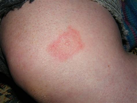 Lyme Disease Tick Bite Showing Lyme Disease Rash By Monkeypuzzle