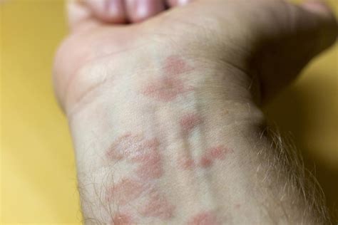 Allergic Eczema Causes Symptoms And Pictures