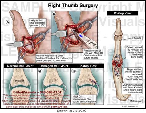 Right Thumb Surgery Medivisuals Medical Illustration