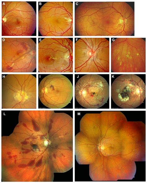 Clinical Features Of Pseudoxanthoma Elasticum On Funduscopic