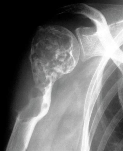 Cancer Of The Shoulder Photograph By Zephyrscience Photo Library