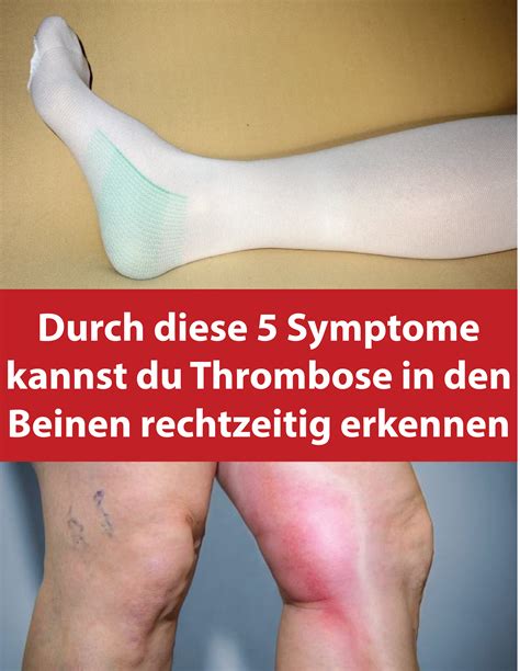 Thrombosen in tiefer liegenden venen (phlebothrombose). Durch diese 5 Symptome kannst du Thrombose in den Beinen ...