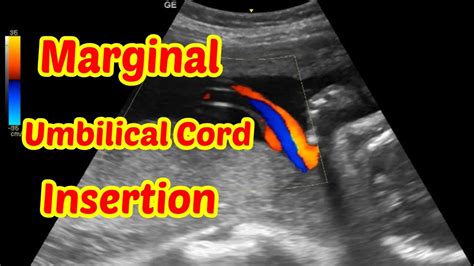 Marginal Umbilical Cord Insertion Youtube