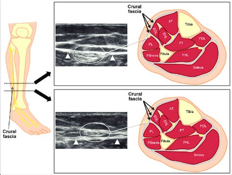 Llustrations Of Superficial Peroneal Nerve Spn Anatomy At Crural