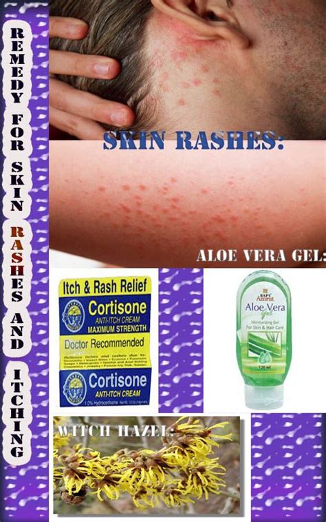 Natural Remedies To Easily Recover From Skin Rashes And Itching Health And Beauty Natural