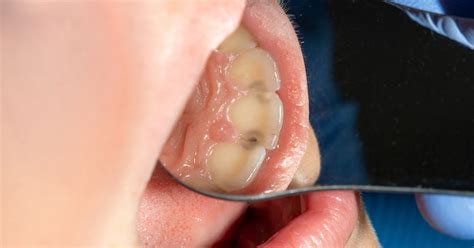 The 7 Most Common Mouth Infections Causes And Symptoms 2024