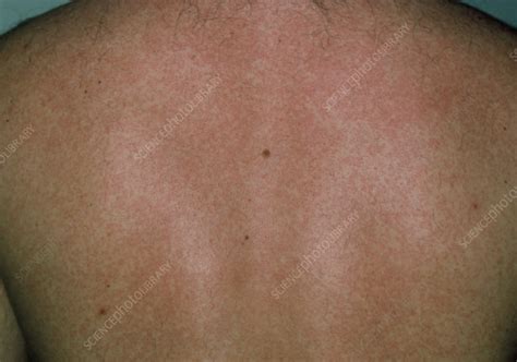 Man Affected By Rubella German Measles Stock Image M2100115