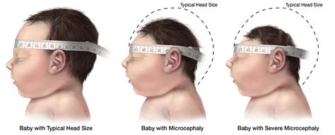 Severe illness and death are rarely a result of a zika virus infection. Symptoms, Diagnosis, Prevention - The Zika Virus