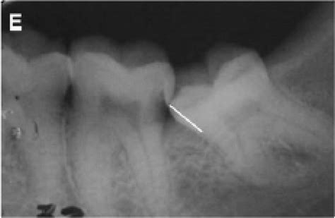 New Concepts In Impacted Third Molar Surgery Intechopen