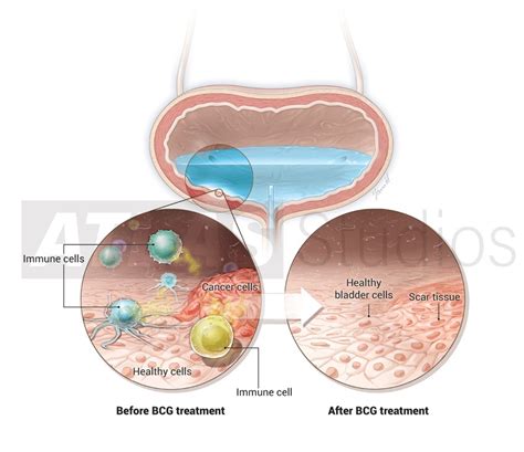 Bcg Treatment For Bladder Cancer Illustration By Atlas Studios