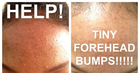 How To Get Rid Of Small Acne Bumps On Chin Mang Temon