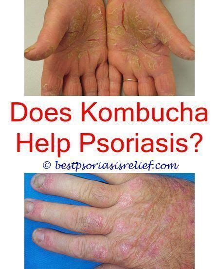 Psoriasisonlips Psoriasis Raptiva Psoriasis Symptoms On Hands