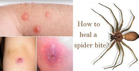 A spider bite typically looks like two small red holes on your skin, like many other bug bites. How to heal a spider bite fast? | Spider bites, Home ...