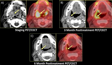 A T4an1m0 Squamous Cell Carcinoma Of The Right Palatine Tonsil Staging