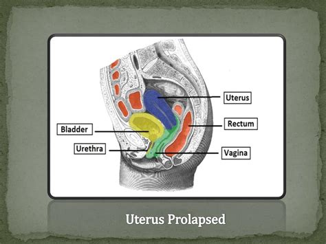 Ppt Proven Tips To Reverse Prolapsed Uterus Powerpoint Presentation
