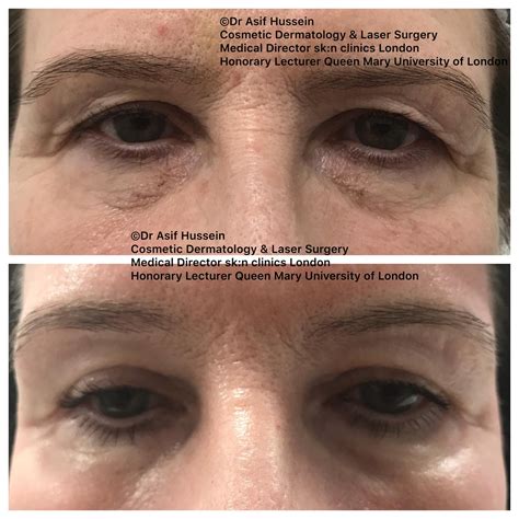Laser Eyelid Tightening Surgery And Treatment Dr H Consult