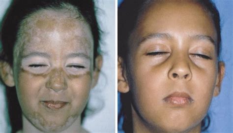 Maladie Du Vitiligo Causes Symptômes Et Traitement Des Taches