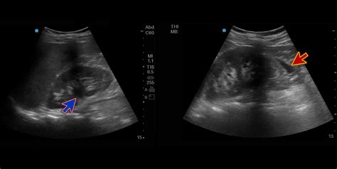 Cureus Appendicitis Mimicking Urinoma A Challenging Emergency Presentation Secondary To