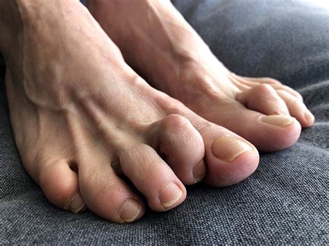 Treatments For Hammer Toes — Lighthouse Foot And Ankle Center