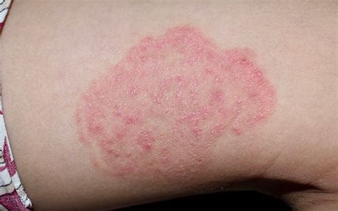 Bacterial Rash On Legs