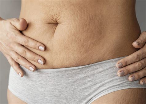 Understanding Stretch Marks After Weight Loss