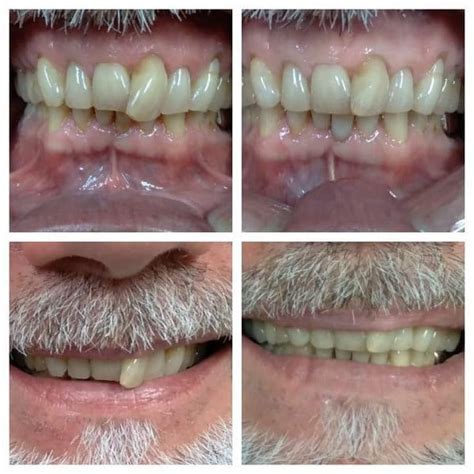 Do You Want To Smile Again Consider Teeth Reshaping Mydental Tampa