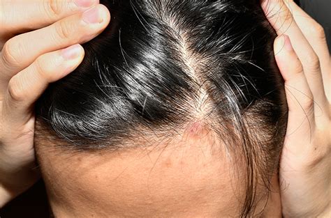 Bikin Rambut Rontok Ini Tanda Infeksi Jamur Pada Kulit Kepala
