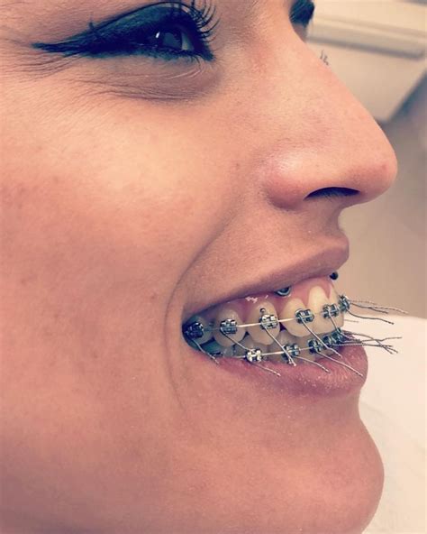 braces girlswithbraces metalbraces braces colors teeth braces dental braces