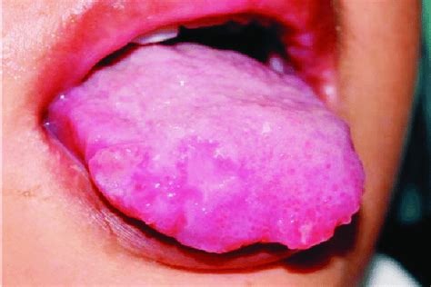 Irregular Ulcers On The Lateral Border And Dorsal Of The Tongue Were
