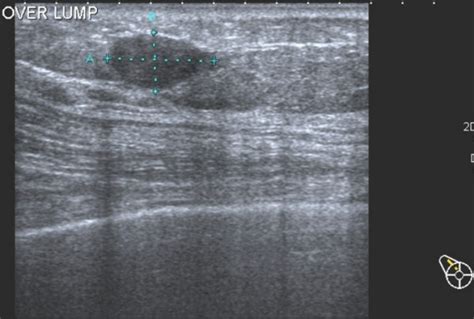 Ultrasonography Showing Hypoechoic Mass In The Right Breast Download