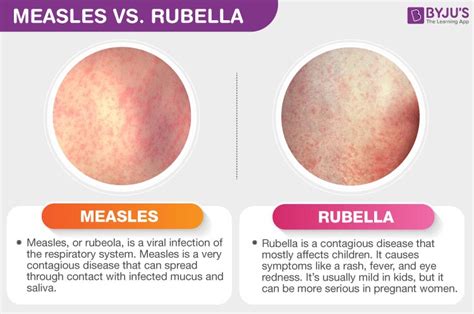 Difference Betwen Measles And Rubella Measles Vs Rubella Byju S