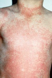 Hautausschlag tritt vergleichsweise selten auf, jedoch kann der ganze körper von roten pünktchen. Krankheiten: Kinderkrankheiten - Krankheiten ...